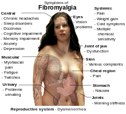 fibromyalgia_symptoms-svg