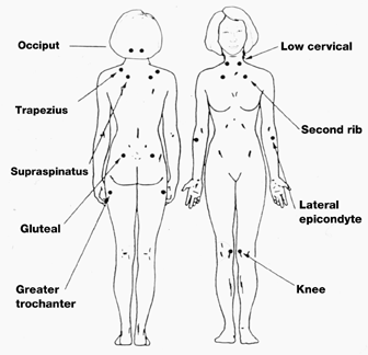 overview tenderpoint diagram for fibromyalgia