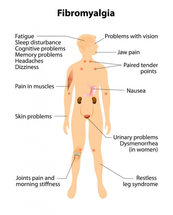 Fibromyalgia Center | Symptoms, Treatments, Pain Relief, Causes