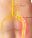 Sciatica
