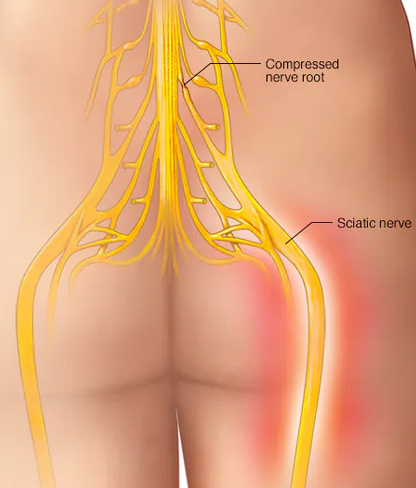 Sciatica